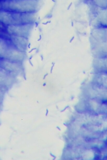 Helicobacter pylori en un caso de gastritis