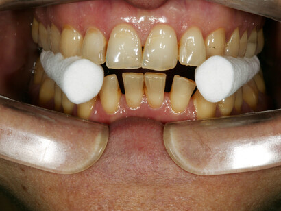 Test di Meersemann. Geniale punto di unione tra odontoiatria e postura. Un metodo di conduzione della visita semplice ed economico. Due rullini di cotone eliminano un contatto dentale diagnosticato come patologico e ne simulano in modo estemporaneo uno corretto che potrebbe tradursi in un bite oppure in un apparecchio ortodontico funzionale. 

