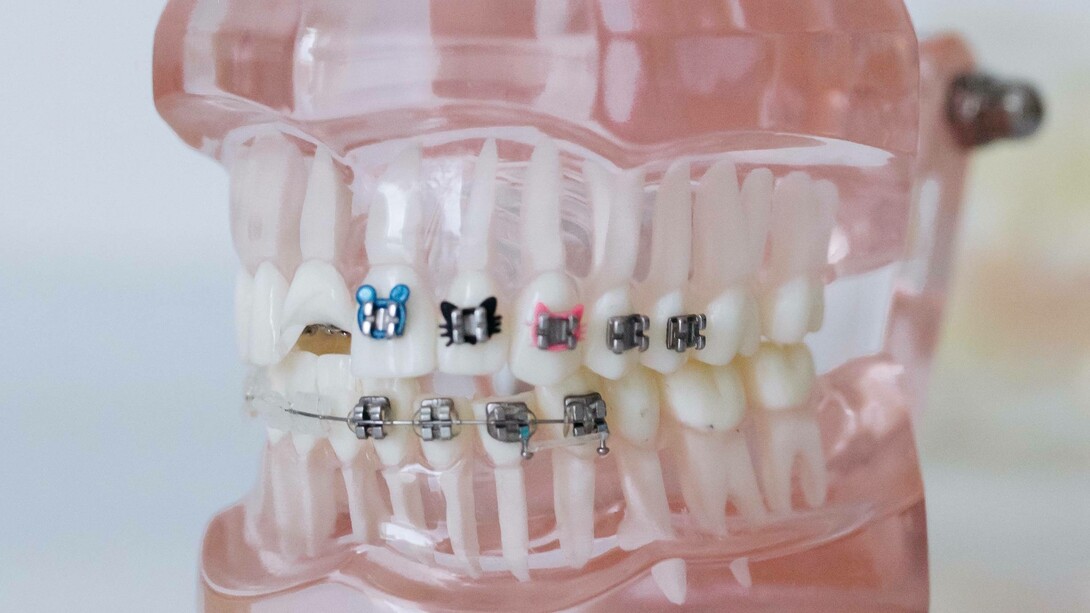 Jaw impression with braces
