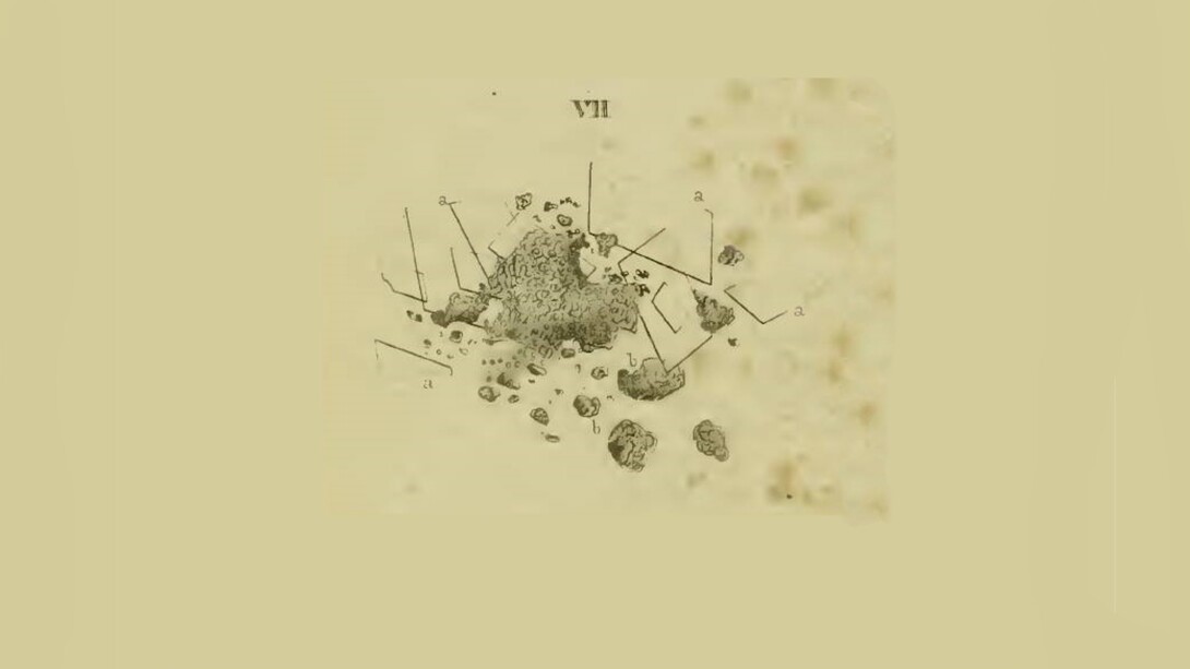Riproduzione dell'aspetto microscopico del materiale ateromatoso nelle tavole del libro di Jiulius Vogel "Icones Histologiae Pathologicae", 1843