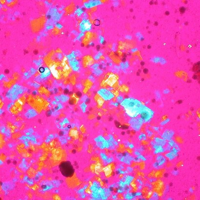 Cristalli di colesterolo nel liquido sinoviale (polariscopia compensata). Immagini patologiche e istologiche di Ed Uthman
