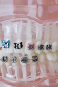 Jaw impression with braces