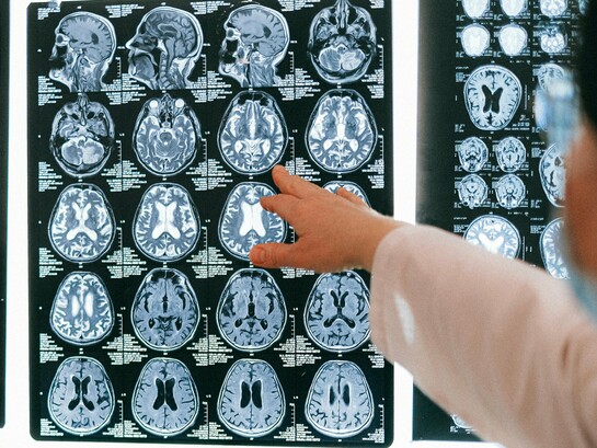 A Síndrome de Stiff-Person, também conhecida como Síndrome da Pessoa Rígida, é uma doença neurológica rara, crónica e potencialmente incapacitante. Ainda assim, permanece pouco conhecida fora dos círculos especializados. O resultado é previsível: anos de consultas, exames inconclusivos, diagnósticos fragmentados e uma sensação recorrente de não reconhecimento por parte de quem procura ajuda