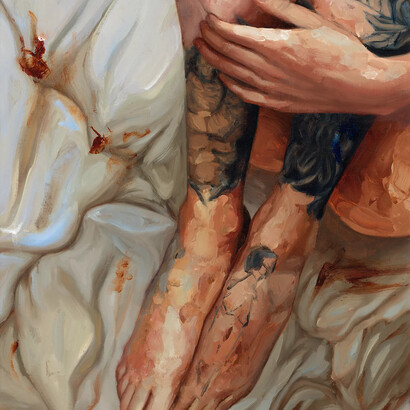 Endometriosis (Causatum), 2018