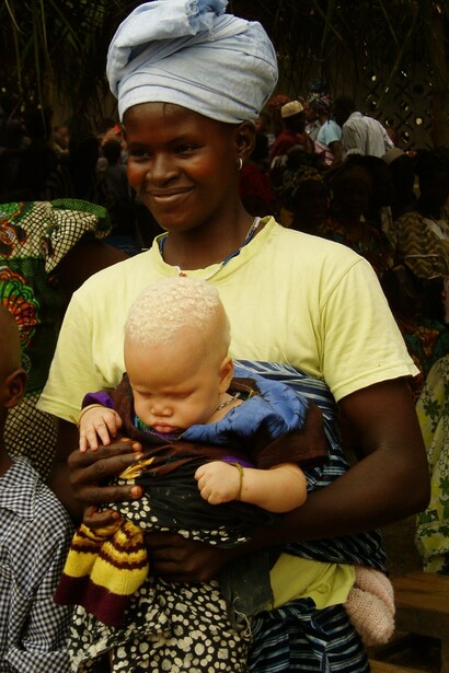 Madre africana con su bebé albino