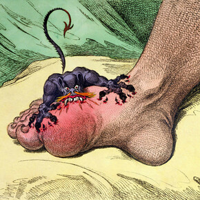 James Gillray (1757‒1815), The Gout, 1799, Hand-coloured soft ground etching, 26 x 35.5 cm © Courtesy of the Warden and Scholars of New College, Oxford / Bridgeman Images