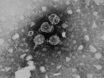 Micrografía mostrando viriones de hepatitis B.