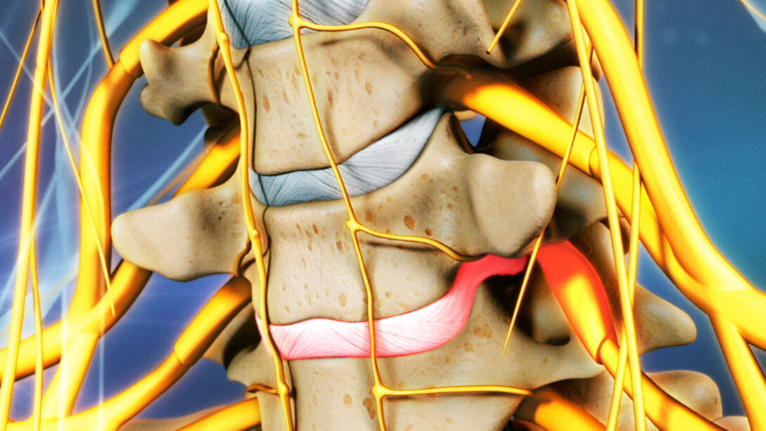 Esquema de una hernia discal lumbar