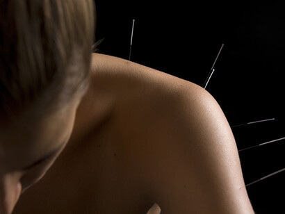 La acupuntura, una técnica de medicina natural
