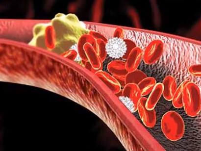 Arteria colpita da colesterolo