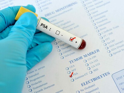 Il PSA Test: è davvero utile?