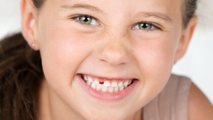 A little girl affected by hypodontia