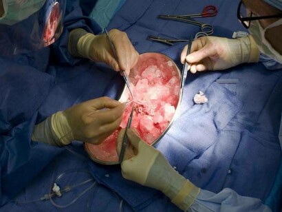 Cada año se realizan más de 100.000 transplantes de órganos en el mundo