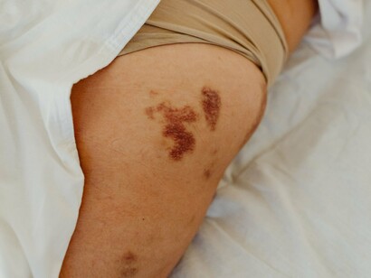 Uma pessoa está deitada na cama, com parte da perna descoberta e marcas visíveis na pele. A observação de alterações cutâneas faz parte da atenção à saúde, mas nem toda marca representa uma doença grave. No melanoma, o reconhecimento de mudanças suspeitas e a avaliação por um profissional de saúde podem contribuir para um diagnóstico precoce