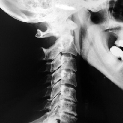 Radiografía de lordosis cervical