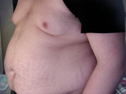 En países de ingresos más altos, como Japón, Canadá y algunos países de Europa occidental (como Francia, España y Dinamarca), no se observaron cambios, o incluso una pequeña disminución en las últimas tres décadas.   
Adolescente obeso,16 años, peso 136 kg