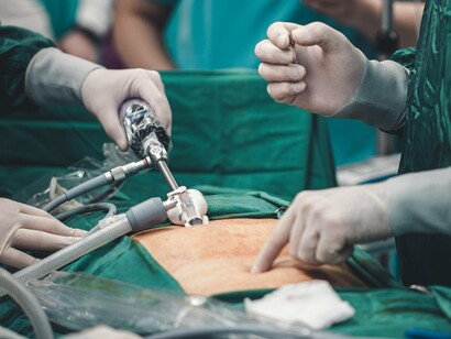 Cirurgia feita por laparoscopia. A integração da robótica à medicina cirúrgica trouxe mais segurança, precisão e controle

