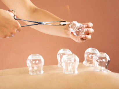 Cupping therapy