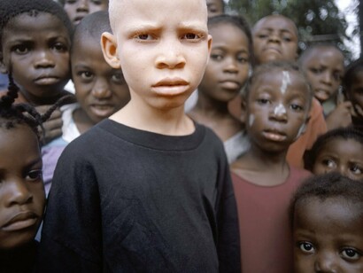 Niño albino africano