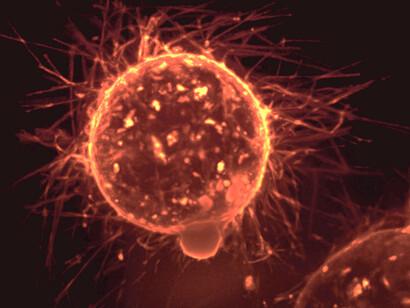 Long-term electromagnetic exposure to microwave radiation is associated with cancer (here breast cancer metastasis)