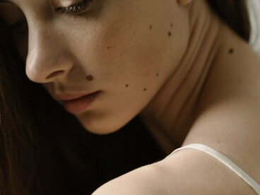 A close-up of multiple skin spots and moles, reflecting the value of recognizing changes that may warrant medical attention
