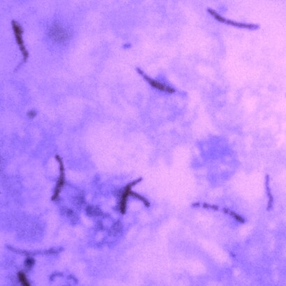 «Mycobacterium tuberculosis»: visualización con el uso de la tinción de Ziehl Neelsen