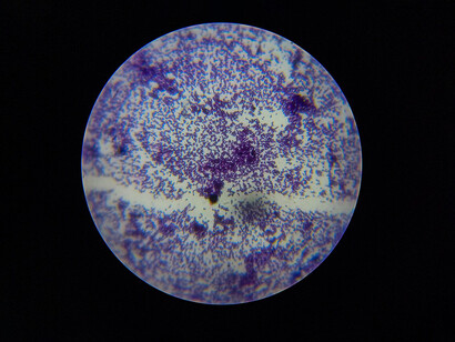 Coloración de Gram de Estreptococos, bacterias con forma esférica que se agrupan en cadenas y pueden identificarse por su patrón de tinción
