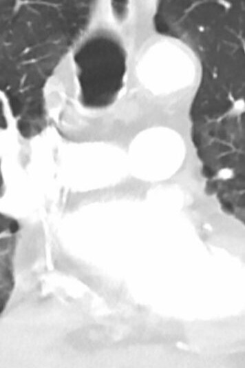 Neumonía causada por el COVID-19