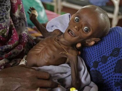 Starving child in Somalia