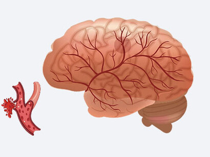 El CVA hemorrágico se conoce como derrame cerebral. Ocurre cuando se rompe uno de los vasos sanguíneos;   y la sangre se acumula en el tejido cerebral. Esto hace que las neuronas se debiliten y mueran