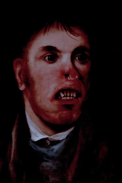 Retrato de J. Kay, afectado de una enfermedad que hoy en día se supone sífilis hereditaria

