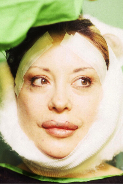 Orlan surgery, 1990-1993