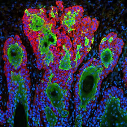 Anticancer drugs: cancer is not just one disease – it is many diseases 