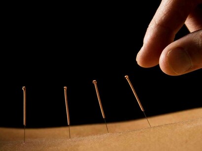 Acupuncture session