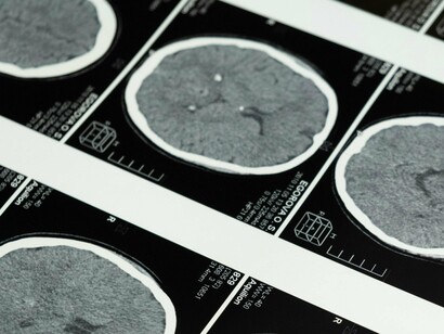 Em termos médicos, o tremor é definido como um movimento rítmico e involuntário de uma parte do corpo. Esse movimento pode variar em frequência e amplitude, e pode afetar diferentes partes do corpo, como mãos, braços, cabeça, cordas vocais, tronco e pernas