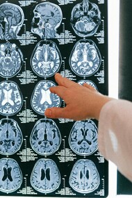 A Síndrome de Stiff-Person, também conhecida como Síndrome da Pessoa Rígida, é uma doença neurológica rara, crónica e potencialmente incapacitante. Ainda assim, permanece pouco conhecida fora dos círculos especializados. O resultado é previsível: anos de consultas, exames inconclusivos, diagnósticos fragmentados e uma sensação recorrente de não reconhecimento por parte de quem procura ajuda