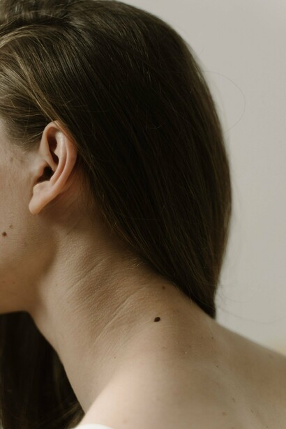 A close-up of naturally occurring moles, symbolizing the importance of becoming familiar with your skin's normal appearance