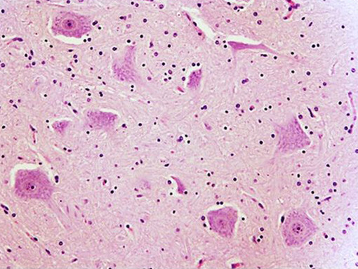 Histopatología de la poliomielitis paralizante