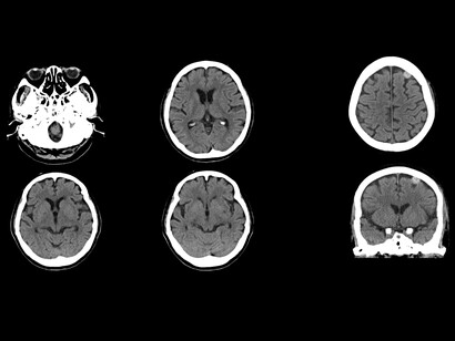 Los síntomas asociados con el parkinsonismo pueden incluir rigidez muscular, el conocido temblor, cambios en el habla y demencia