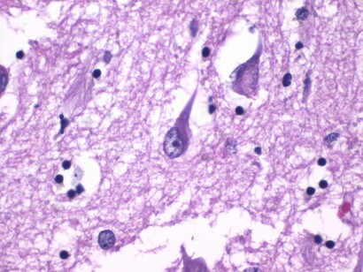 Histopatología de los ovillos neurofibrilares en la enfermedad de Alzheimer. Tinción con hematoxilina y eosina. 11 de agosto de 2020