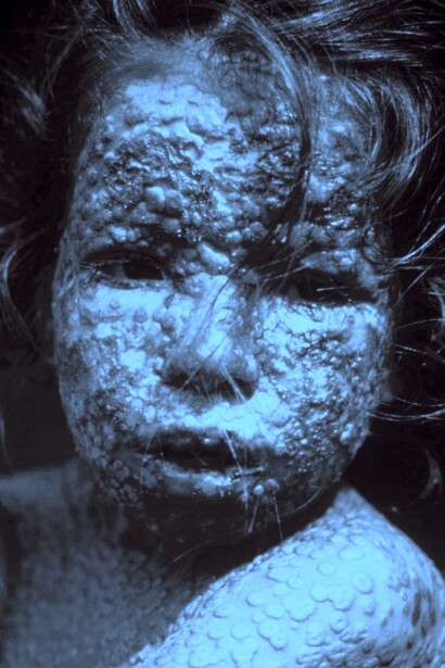 Niña infectada de viruela, cubierta por las características erupciones en la piel. Bangladés, 1973