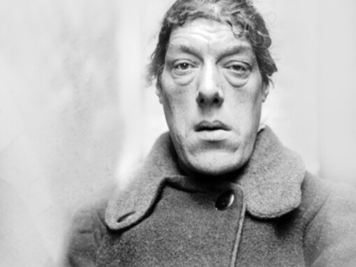 Mary Ann Webster colpita da acromegalia, divenne la "donna più brutta del mondo"