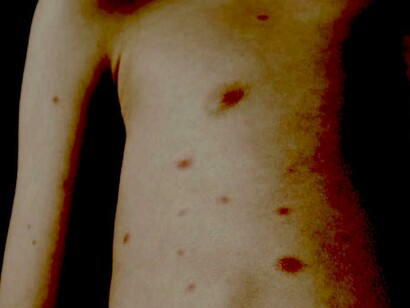 El movimiento antivacunas está consiguiendo que regresen enfermedades que creíamos superadas