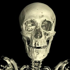 Linenman skull. The CT scan of the skull of the mummy of an adult man (name unknown). The scan shows considerable evidence of dental abbcesses and the loss of several teeth. © Trustees of the British Museum