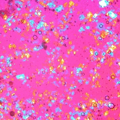 Cristalli di colesterolo nel liquido sinoviale (polariscopia compensata). Immagini patologiche e istologiche di Ed Uthman
