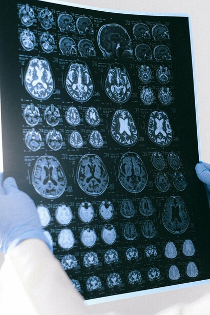 Le lastre di un cervello. L'intuito è strettamente legato alla capacità del cervello di elaborare rapidamente le informazioni