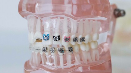 Jaw impression with braces