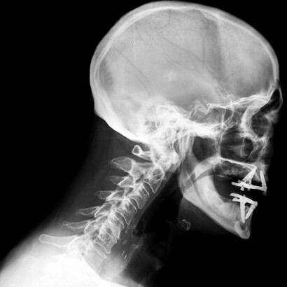 Radiografía de la columna cervical