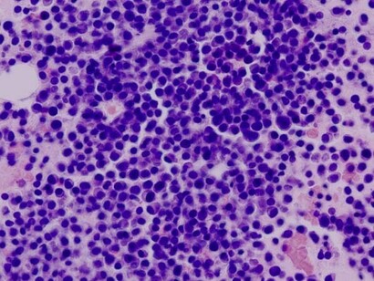 Mieloma múltiple: aspirado de médula ósea; tinción con hematoxilina-eosina