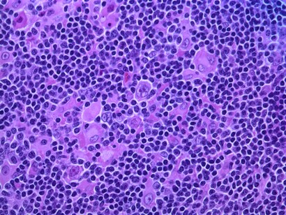 Linfoma de Hodgkin, con predominio de linfocitos nodulares